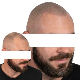 Client de Nat Lambert Tricopigmentation