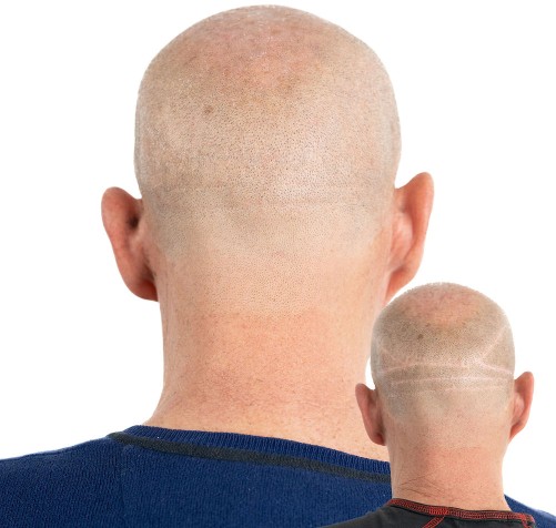 Densification cheveux