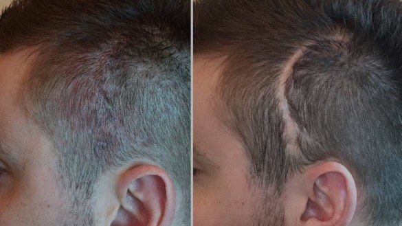 Densification cheveux