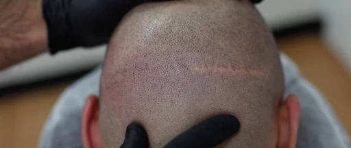 Densification cheveux